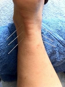 demonstration of acupuncture on ankle