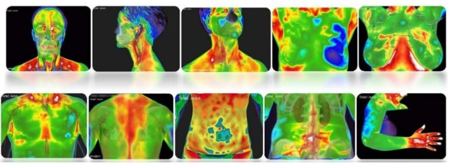 thermographics images from Florida Medical Thermography